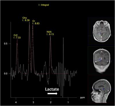 Case report: Late-onset MELAS syndrome with mtDNA 5783G>A mutation diagnosed by urinary sediment genetic testing